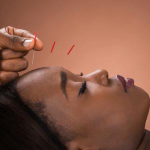 Acupuncture